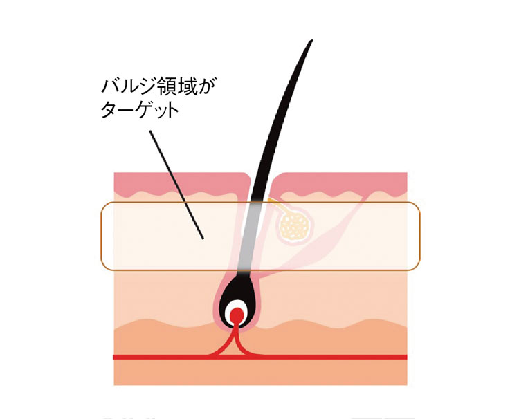 salontool epilation2019 globalscience npl