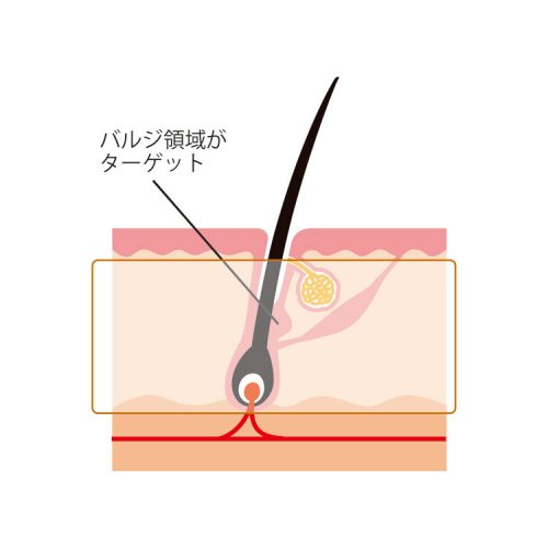 <脱毛機>ヴィクトリアなら脱毛集客はもちろん コース追加まで狙える! 22 salontool machinebest11 2019 globalsc theory1