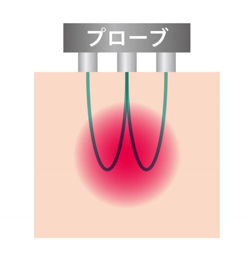 <RF痩身機器>癒しと結果の両方をかなえるハイパーナイフ 22 salontool machinebest11 2019 wamu theory3