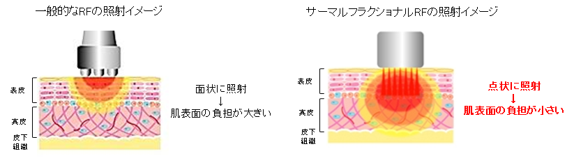 ベストアイテム受賞! サロンから長年愛され続けるBECO JAPANの複合美容機器『BE-BE』と超音波美容機『ハイブリッドフォーカス』を徹底解説! 26 f5a357bd6d270b6f8dbebb461321ed47